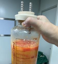 孝昌水动力吸脂手术要做多久？